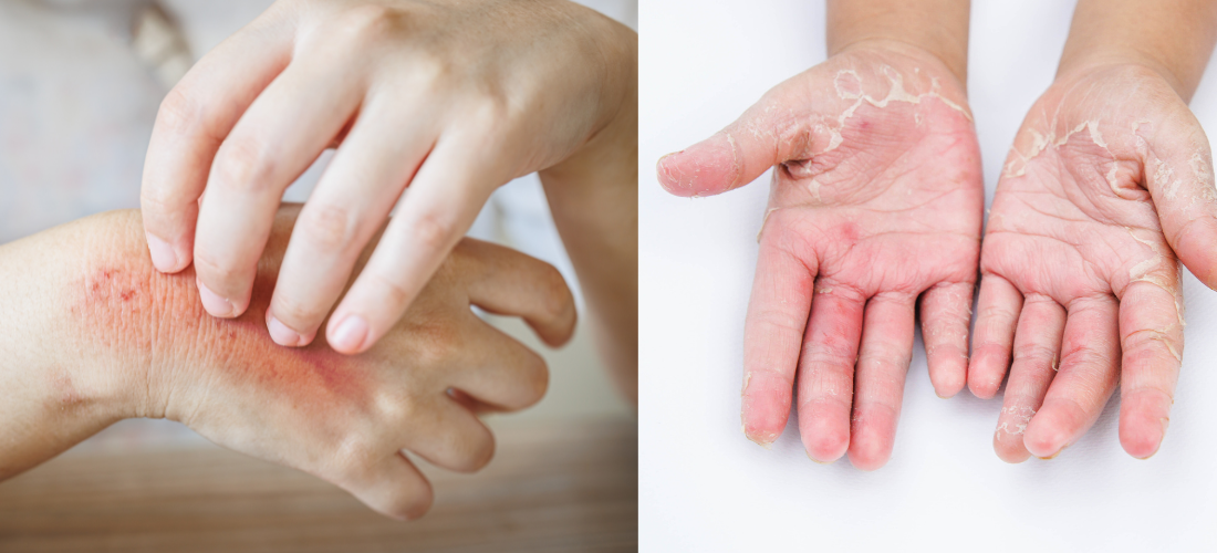 Fungal Infections Treatment